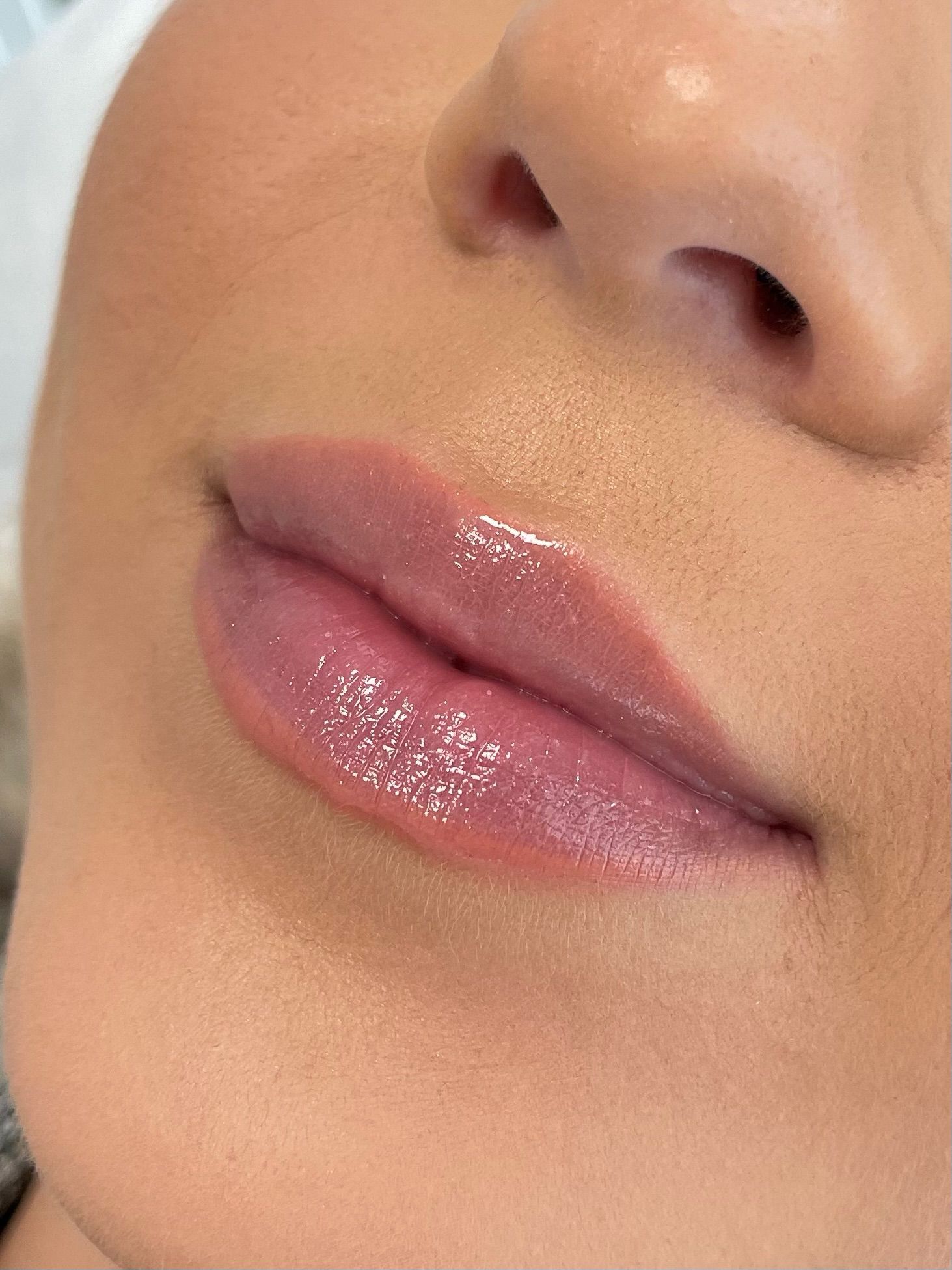 How Often Should You Get Lip Fillers to Maintain Results?