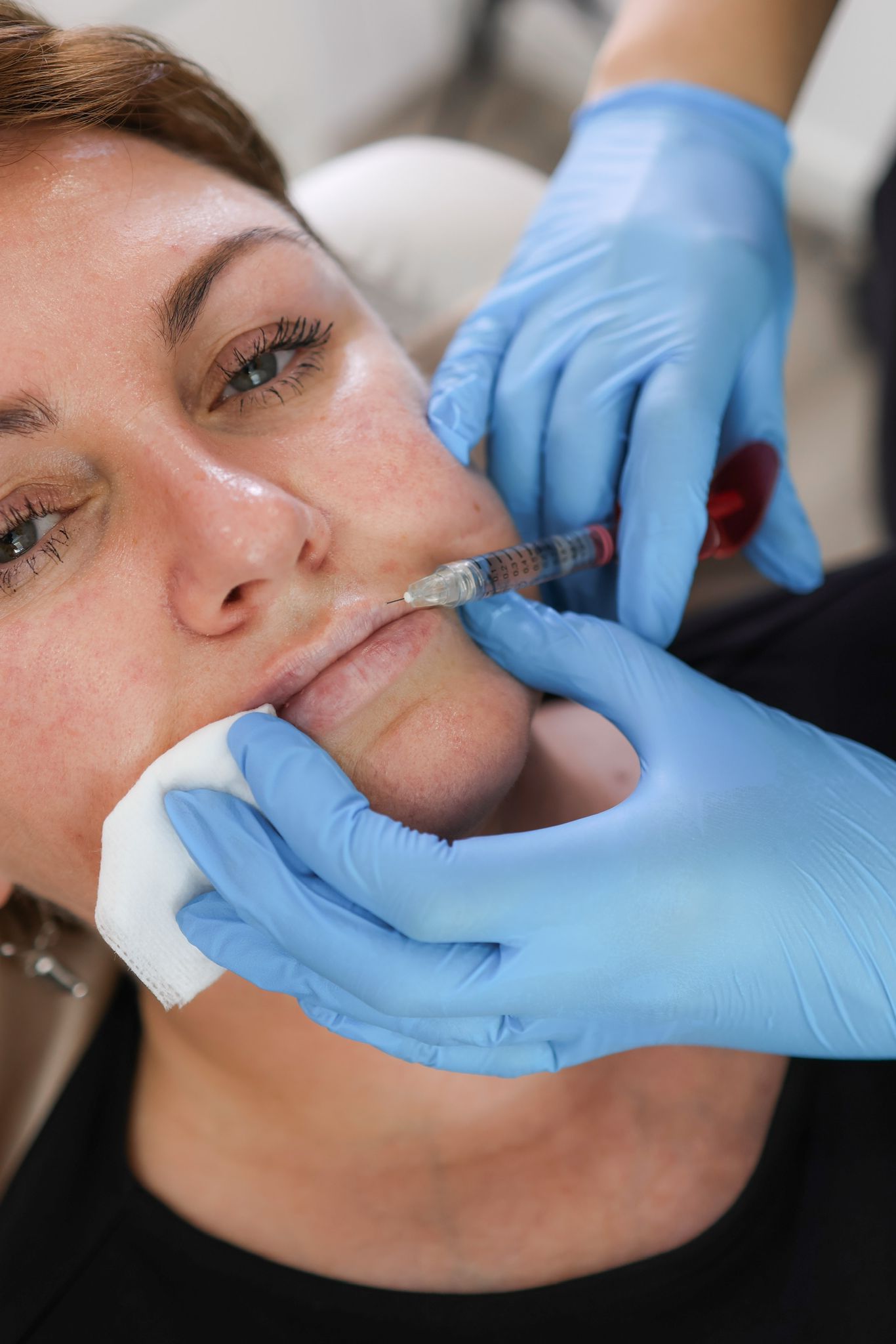 How Lip Fillers Are Revolutionising the Non-Surgical Beauty World