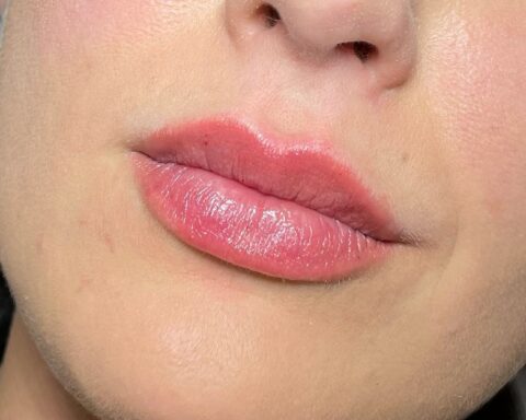 The Benefits of Choosing Lip Fillers Over Lip Implants