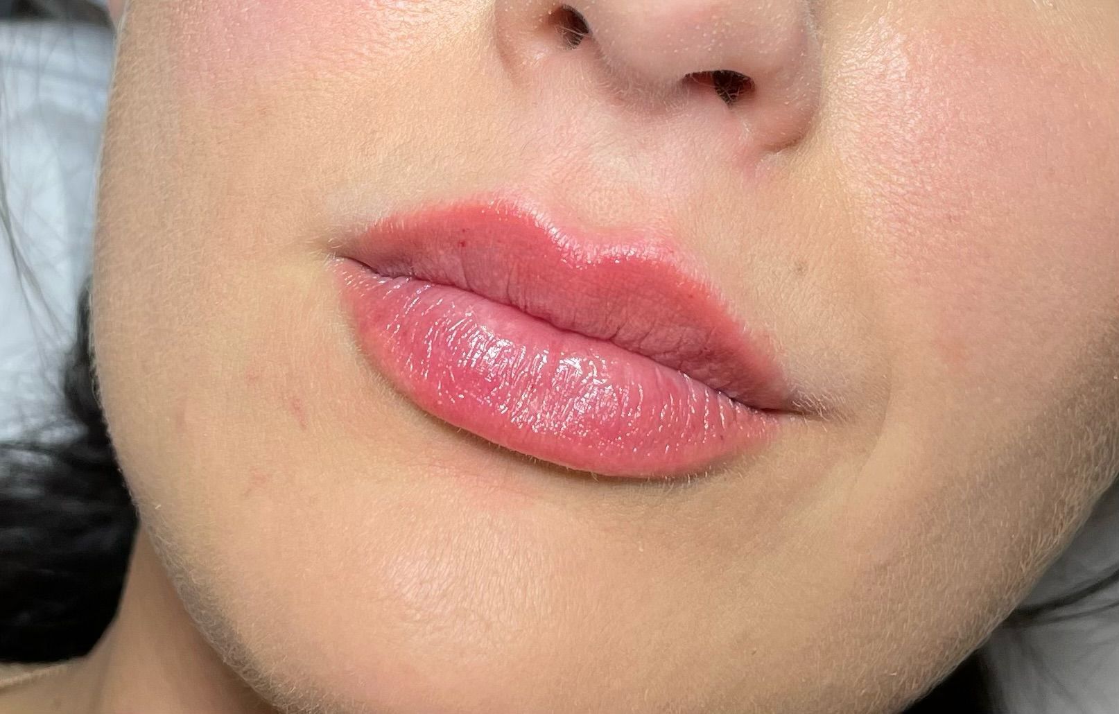 The Benefits of Choosing Lip Fillers Over Lip Implants