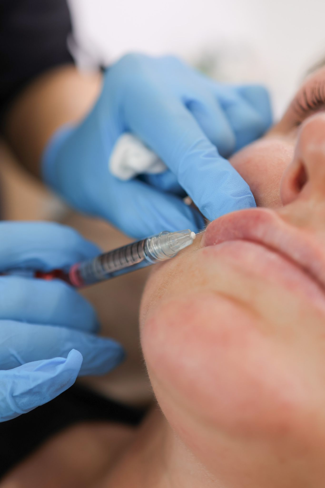 The Growing Popularity of Lip Fillers in the UK