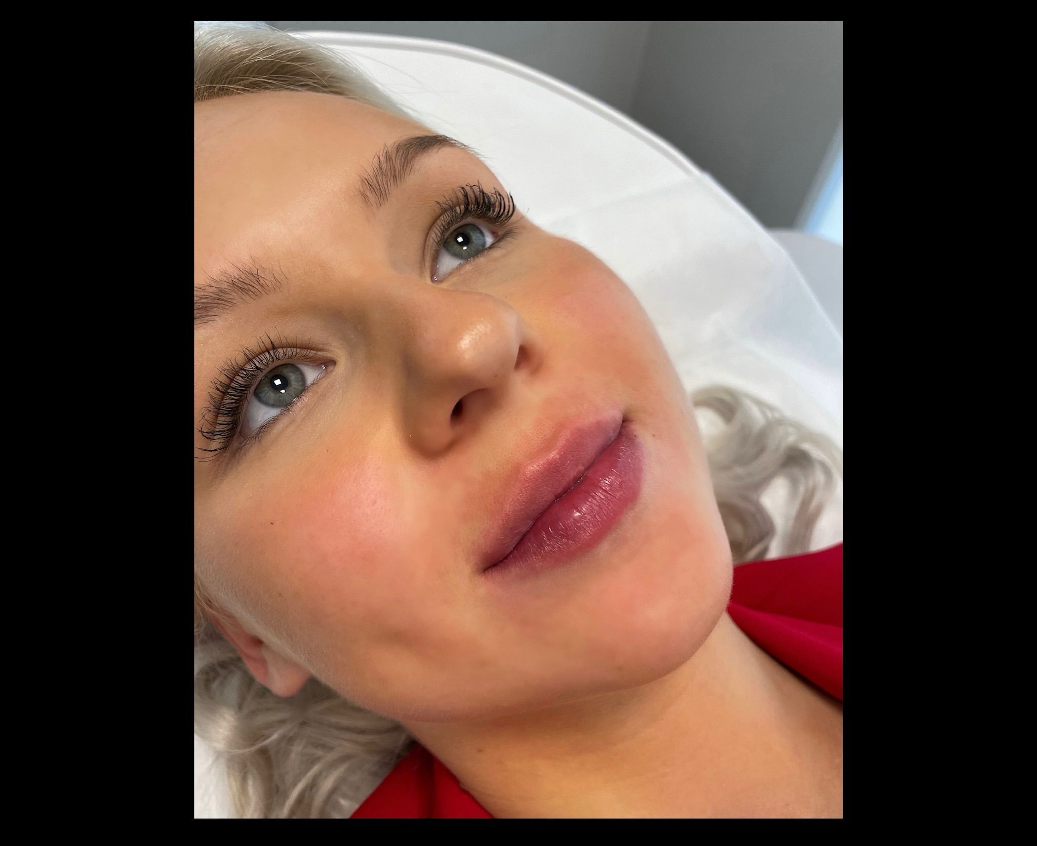 Lip Filler London | Lip Augmentation in London & Natural Lip Enhancement