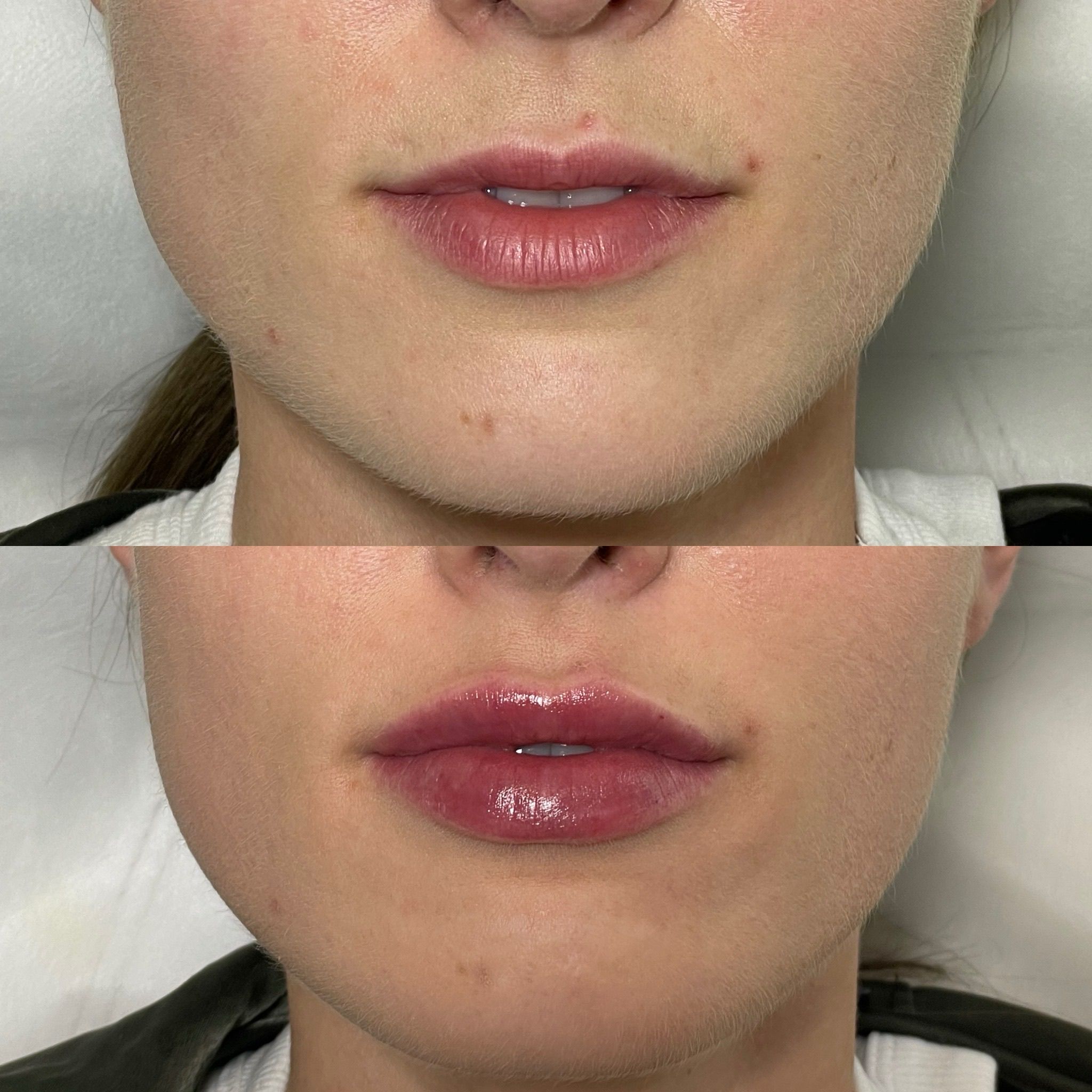 Lip Filler London | Lip Augmentation in London & Natural Lip Enhancement