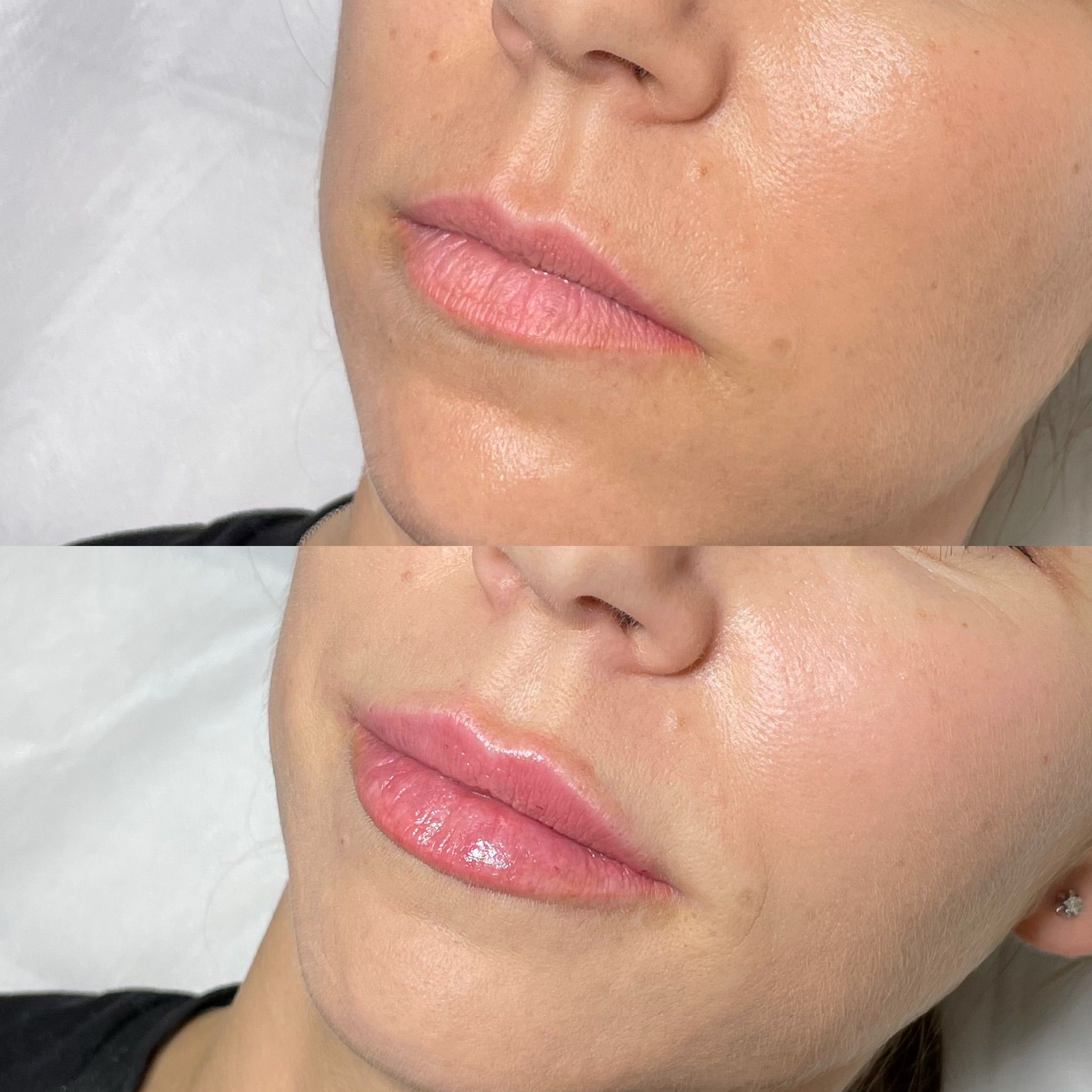 Lip Filler London | Lip Augmentation in London & Natural Lip Enhancement