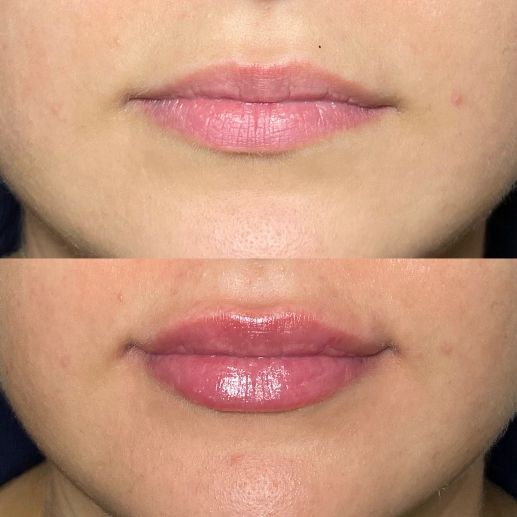 Lip Filler London | Lip Augmentation in London & Natural Lip Enhancement