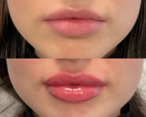 Lip Filler London – Natural Lip Enhancement & Lip Augmentation