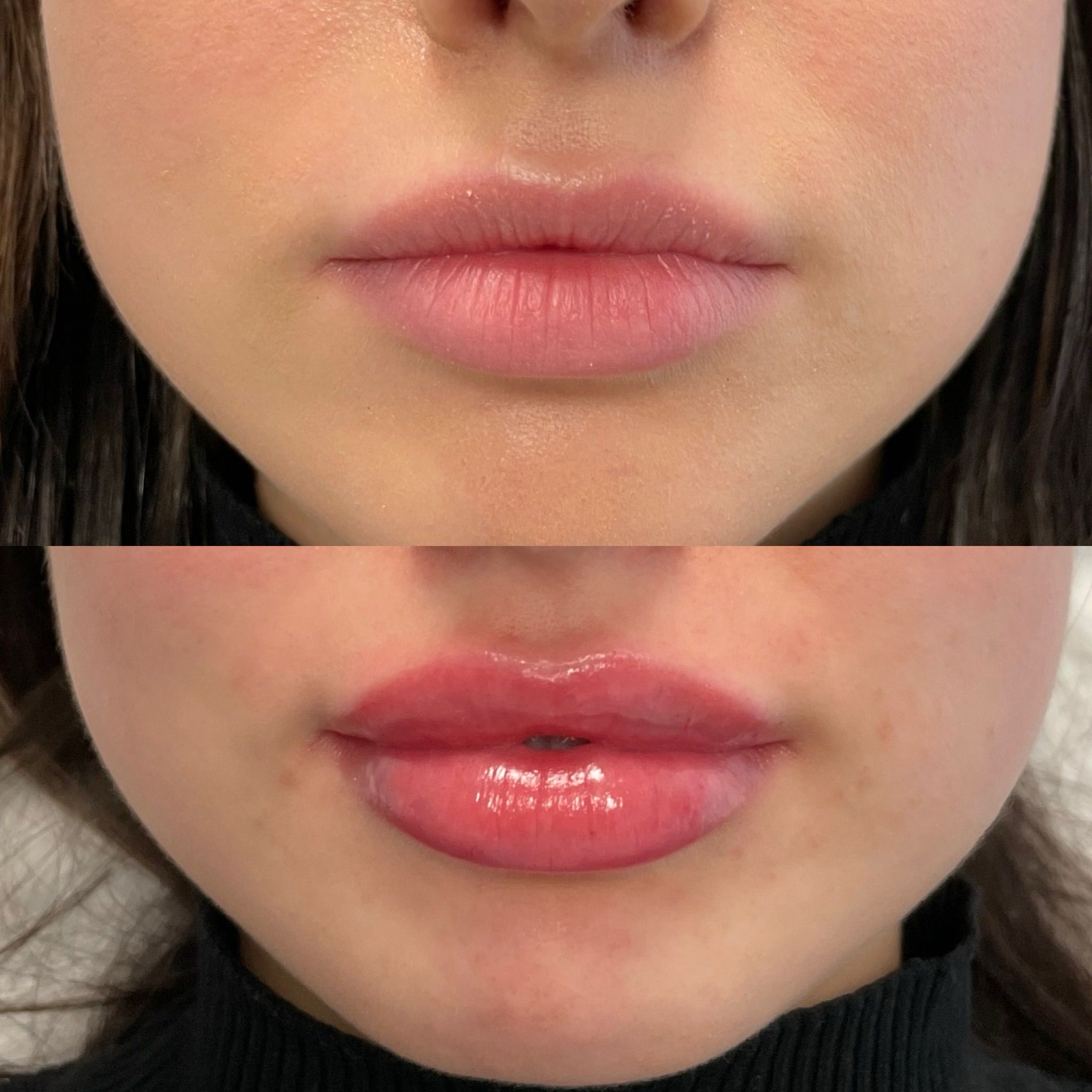 Lip Filler London – Natural Lip Enhancement & Lip Augmentation